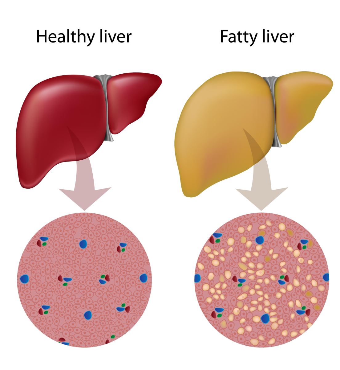 a healthy liver vs a fatty liver, do AI tạo