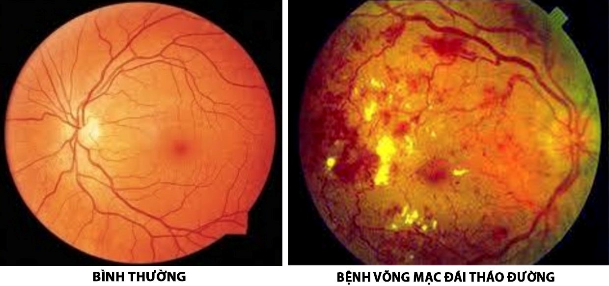 Những nghiên cứu mới về chẩn đoán viêm võng mạc