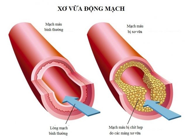 Xơ vữa động mạch: nguyên nhân, triệu chứng và cách điều trị - Family  Hospital